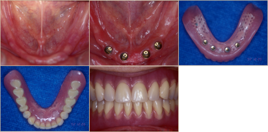 インプラントと入れ歯の症例