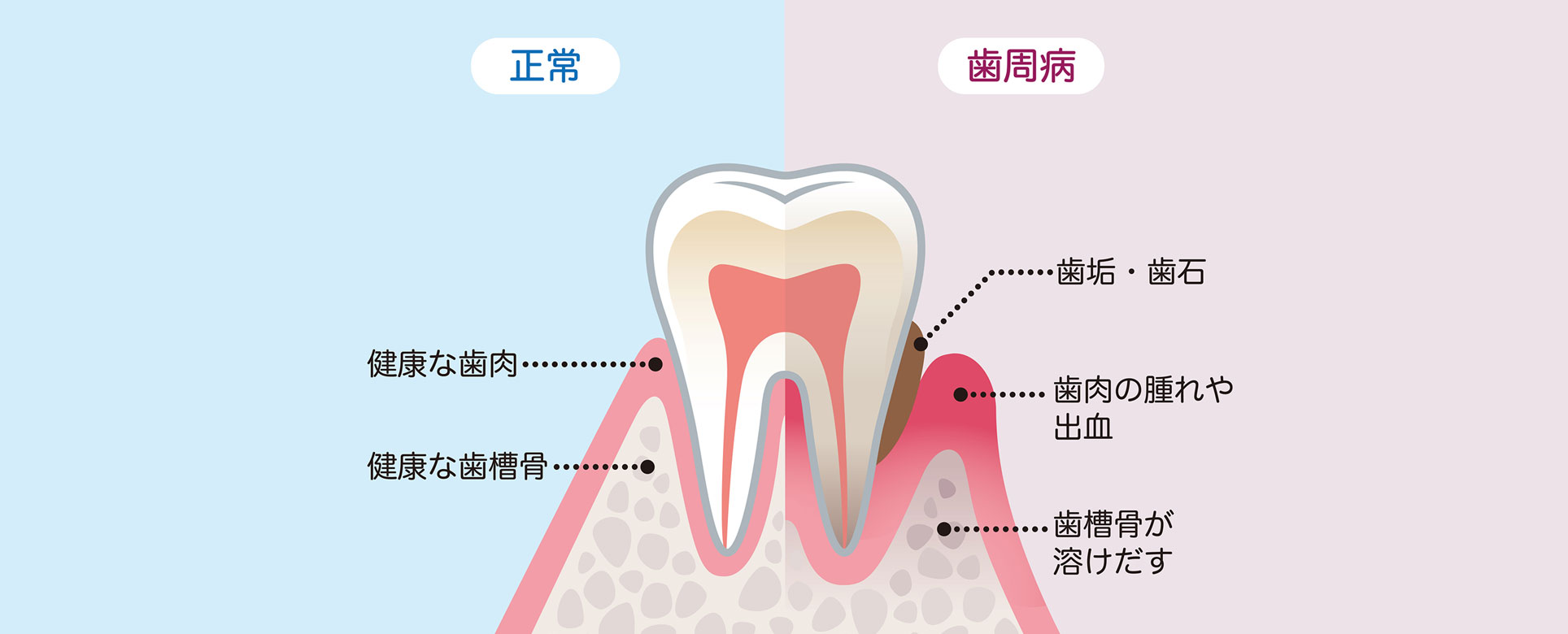 歯周病とは