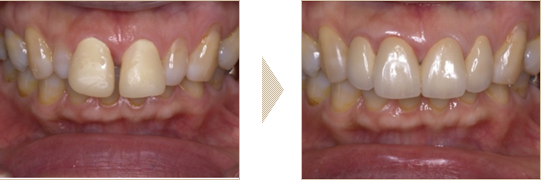 部分矯正とセラミック