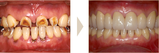 部分矯正と審美治療