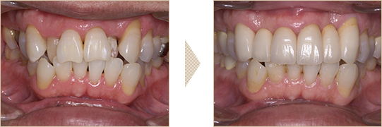 前歯のセラミックブリッジ
