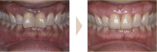 セラミックスクラウンと歯肉ピーリング