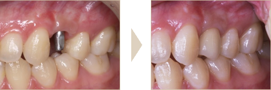インプラント1本の症例