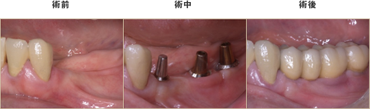 奥歯4本のインプラント症例