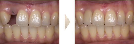 前歯1本のインプラント症例