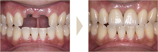 前歯2本のインプラント症例