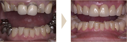 セラミックとインプラント症例