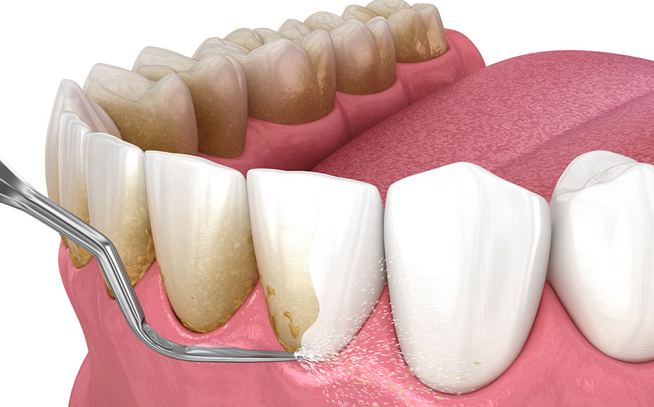 歯石の除去