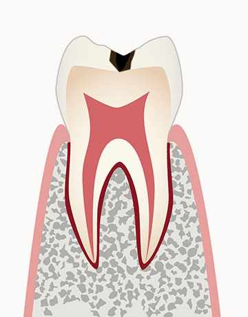 C1 軽度の虫歯