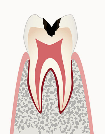 C2 中度の虫歯