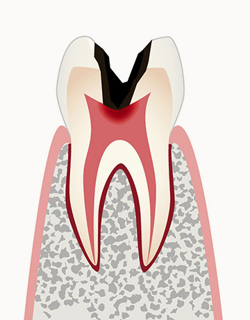 C3 重度の虫歯