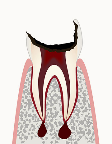 C4 歯髄が壊死した虫歯