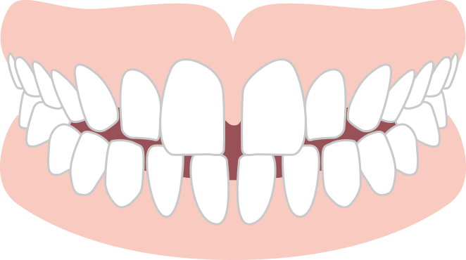 空隙歯列